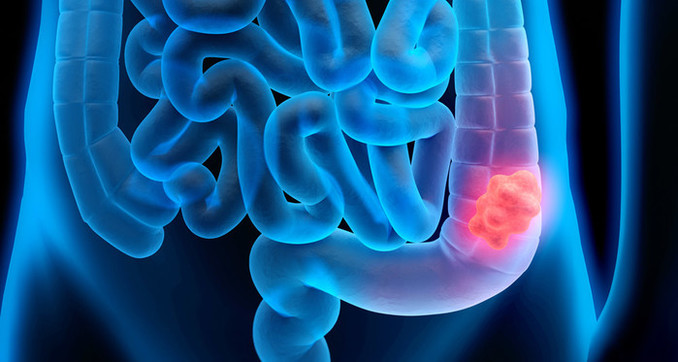 대장암의 원인 중 하나가 바이러스일까요?