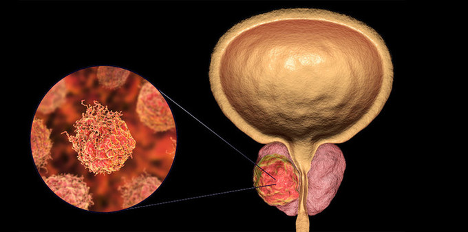 전립선암 종양 샘플에서 미세플라스틱 발견