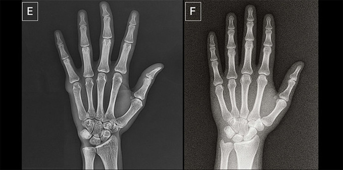 AI 생성 엑스레이, 방사선 전문의까지 속여