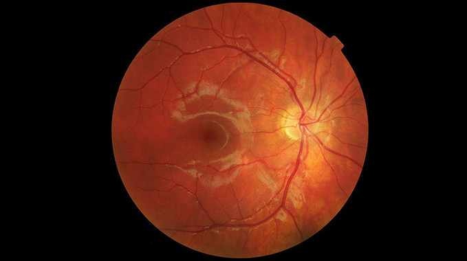 흡연, 눈에도 생각보다 훨씬 심각한 ...